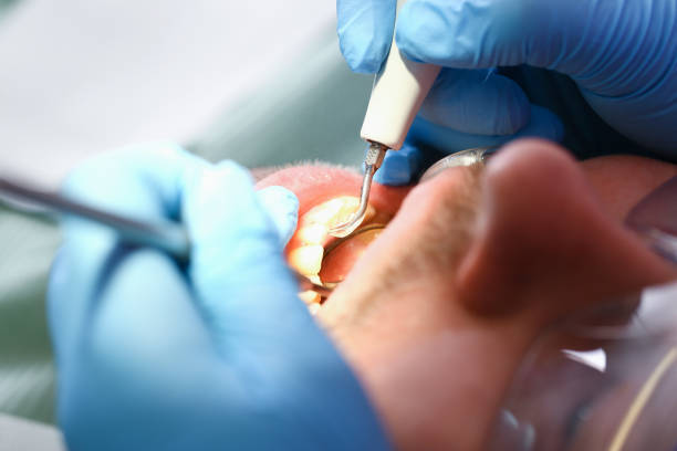 Best Emergency Dental Extractions in Angleton, TX